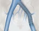 Zilver Venous Self Expanding Stent.jpg